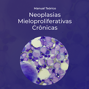 Neoplasias Mieloproliferativas Crônicas